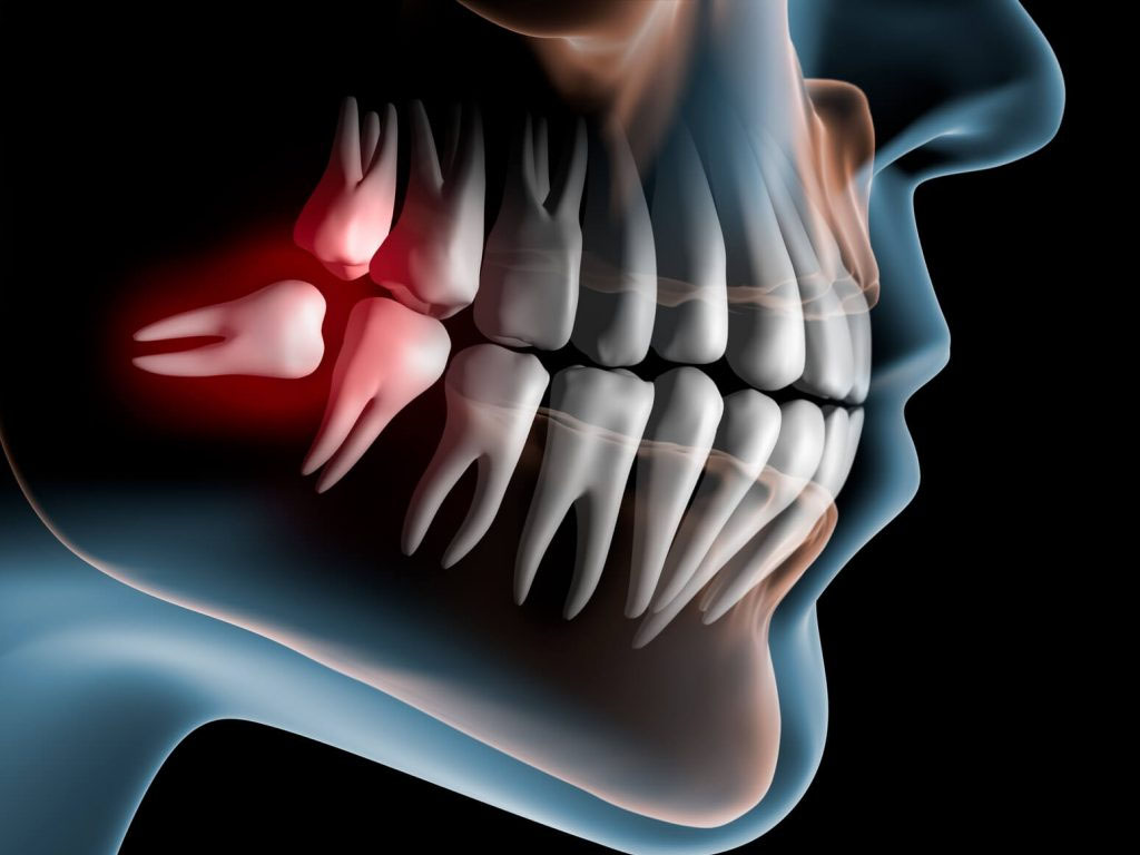 Impacted wisdom tooth illustration
