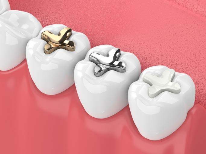 Dental fillings illustration