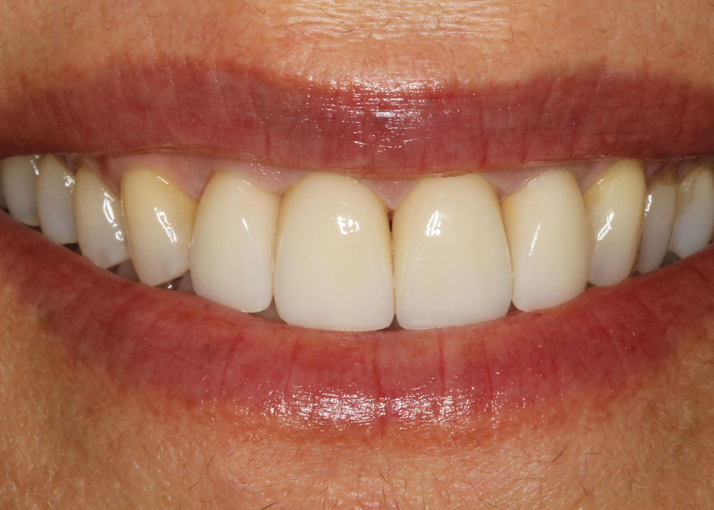 After veneers