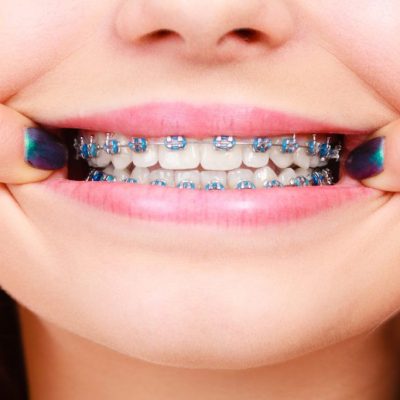 braces on child's smile